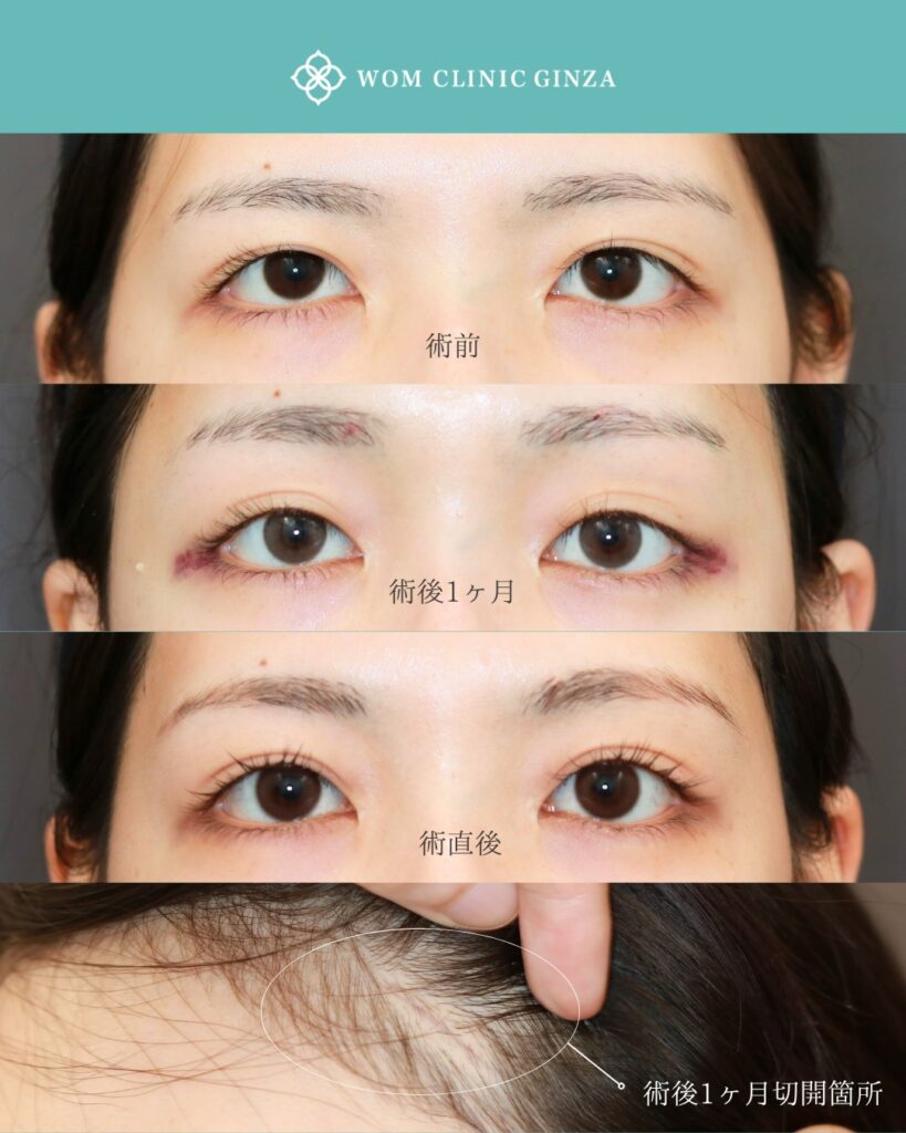 『目元の印象は“上顔面”で決まる:内視鏡額挙上で叶える”愛され顔”』の画像
