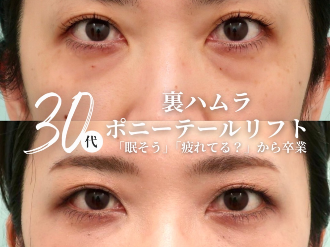 ポニーテールリフト　裏ハムラ