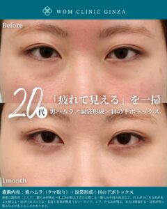 『涙袋は作れる時代へ!裏ハムラ+涙袋形成で自然にぷっくり目元を実現』の画像