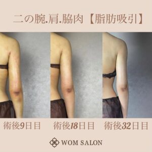 インディバ（ボディ）の症例写真