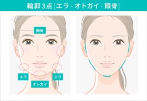 骨切り施術
