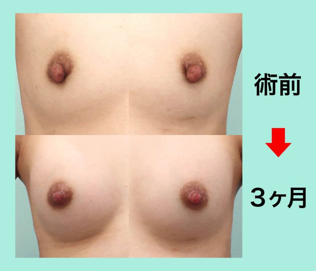 『『 乳頭形成 + シリコンバッグ豊胸 』で完成度の高い胸を作る』の画像