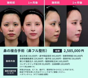 鼻の複合手術の症例