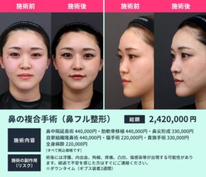鼻の複合手術のビフォーアフター02