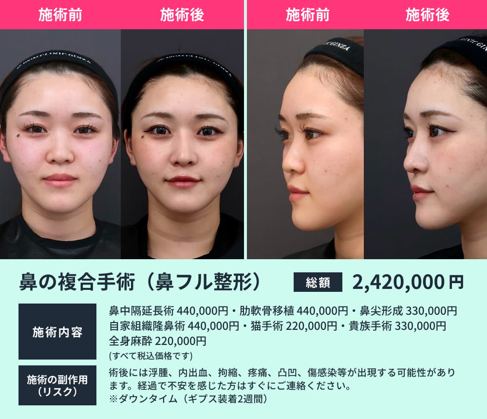 鼻の複合手術のビフォーアフター02