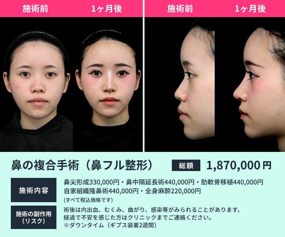 鼻の複合手術のビフォーアフター04