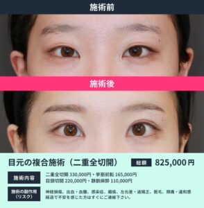 目元の複合施術のビフォーアフター