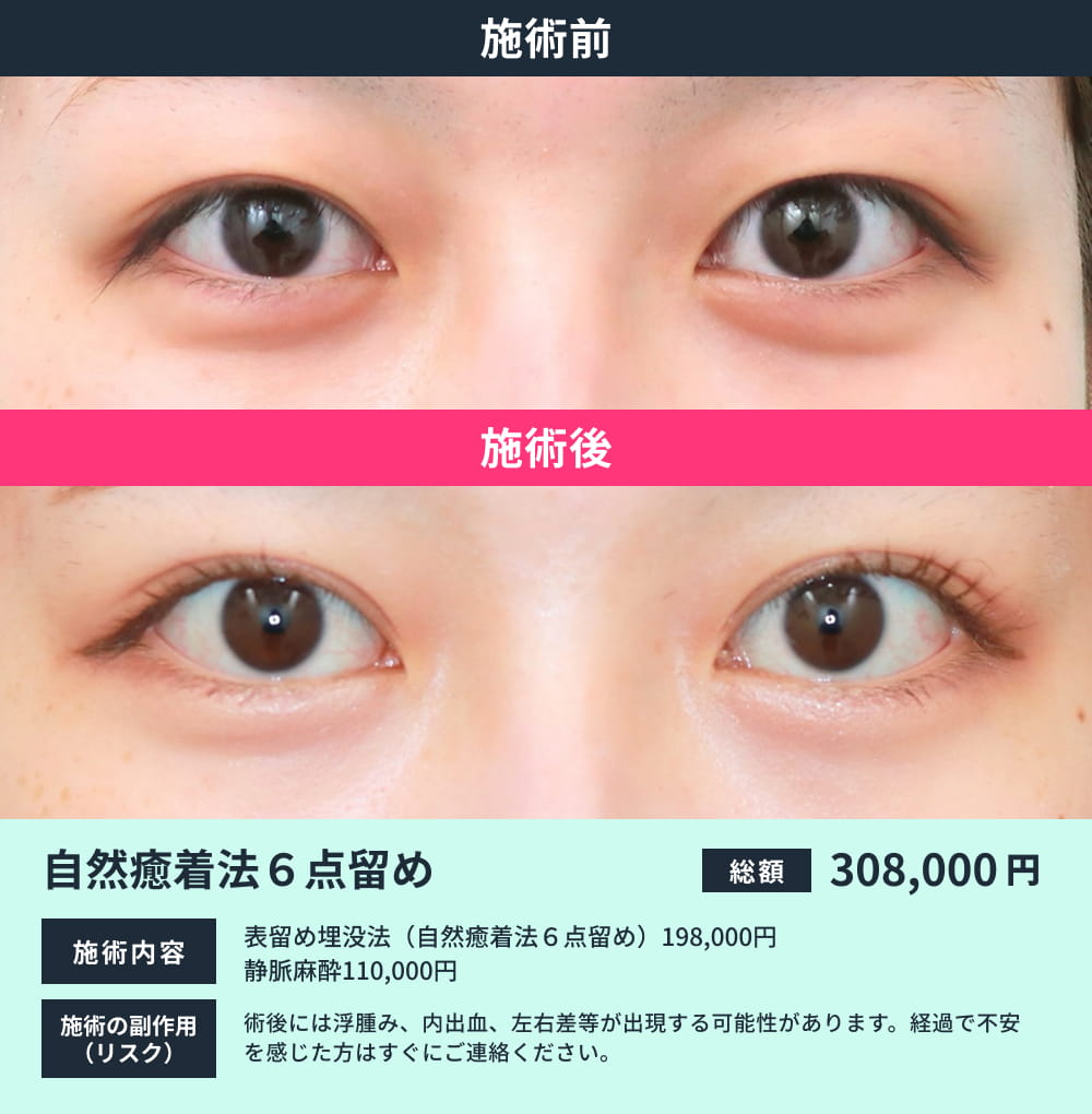 自然癒着法6点留めのビフォーアフター 