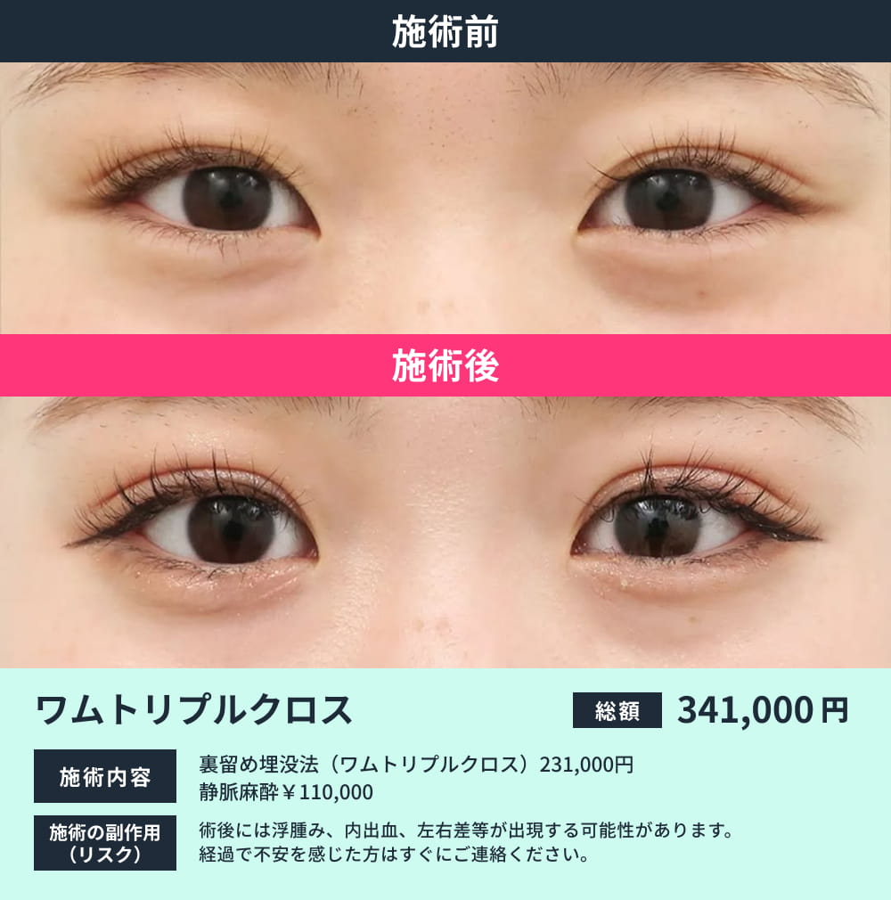 ワムトリプルクロスのビフォーアフター
