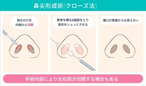 .鼻尖形成術（クローズ法）