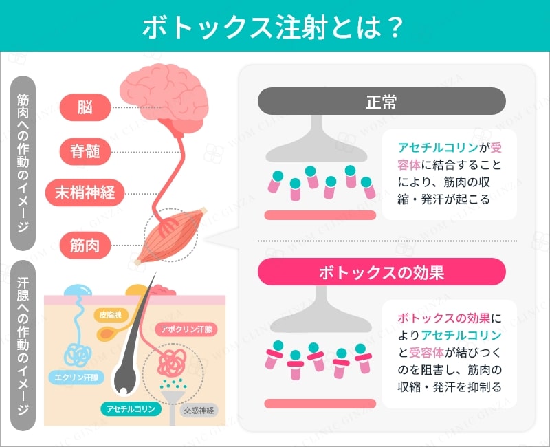 ボトックス注射とは?