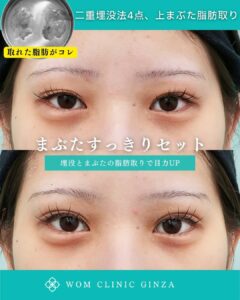 二重埋没スクエアダブル＋上まぶた脱脂の症例写真
