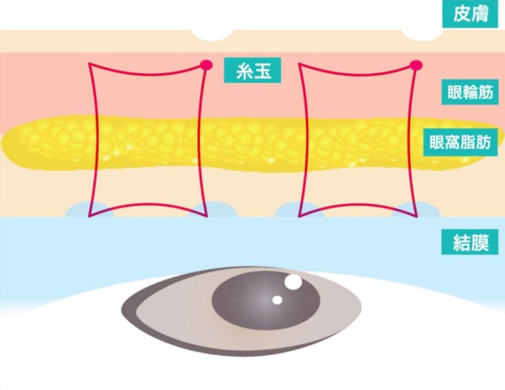 二重埋没法の結び方とまぶたの断面図