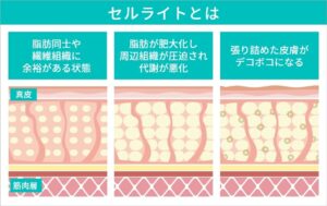 セルライトの特徴