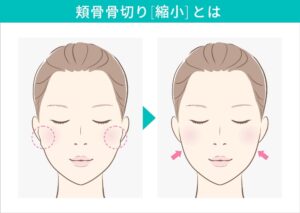 頬骨骨切り（縮小）とは