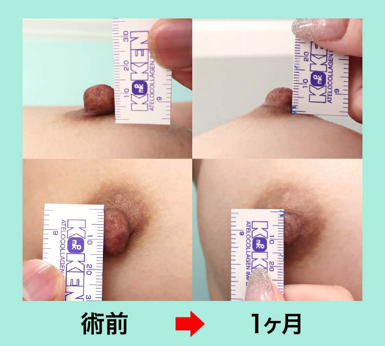 『『 乳頭形成 + シリコンバッグ豊胸 』で完成度の高い胸を作る』の画像