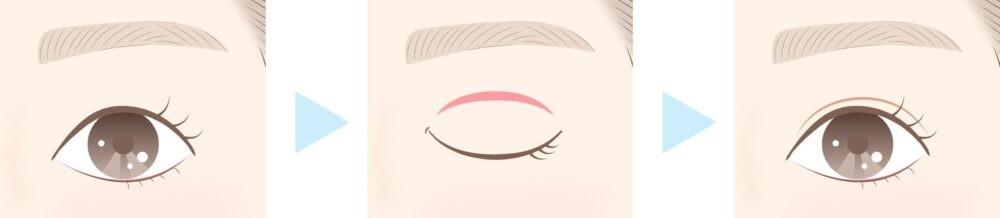 二重切開法の切開位置と術後のイラスト