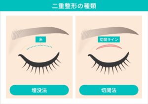 二重整形の種類