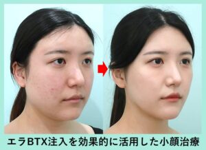 頬+顎下の脂肪吸引+糸リフト+エラボトックス注射の症例写真