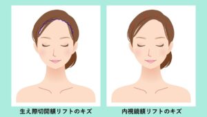 額挙上（前額リフト）のダウンタイム