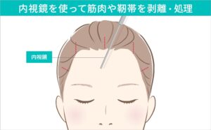 額挙上（前額リフト）の施術方法02