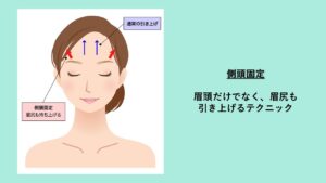 額挙上（前額リフト） 側面固定