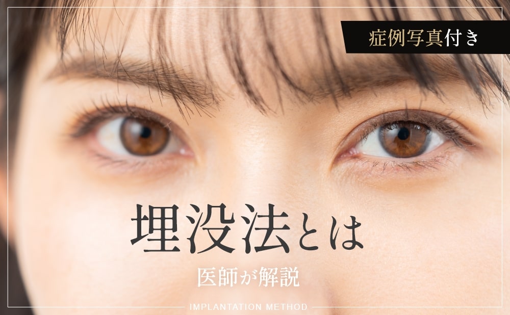 二重埋没法とはどんな施術？メリットや向いている人、当院の症例を紹介