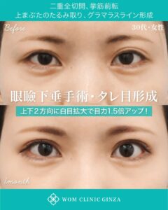 二重全切開＋挙筋前転＋上まぶたのたるみ取り＋切開式グラマラス形成の症例写真