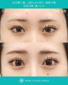 二重全切開＋上瞼たるみ取り＋眼瞼下垂＋目尻切開＋裏ハムラ法の症例写真