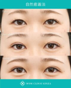 韓国式自然癒着法の症例写真02