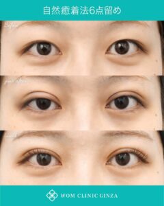 韓国式自然癒着法の症例写真