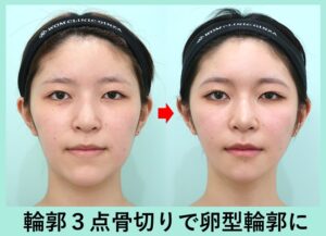 韓国式輪郭3点の症例写真