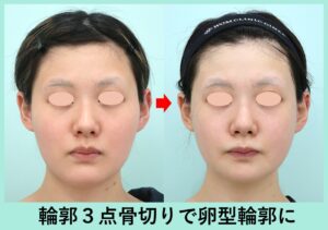 韓国式輪郭3点の症例写真（正面）