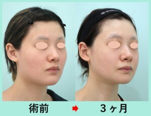 韓国式輪郭3点の症例写真（横）
