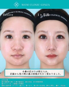 鼻フル整形の症例写真01