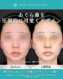 鼻フル整形の症例写真02