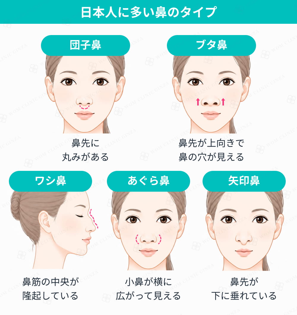 日本人に多い鼻のタイプ分類イラスト