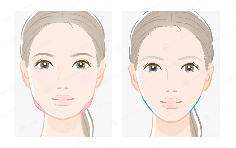骨切りのイメージ