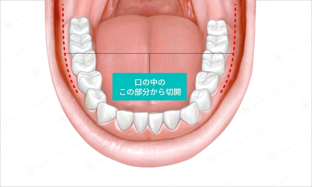 オトガイ形成　口の中