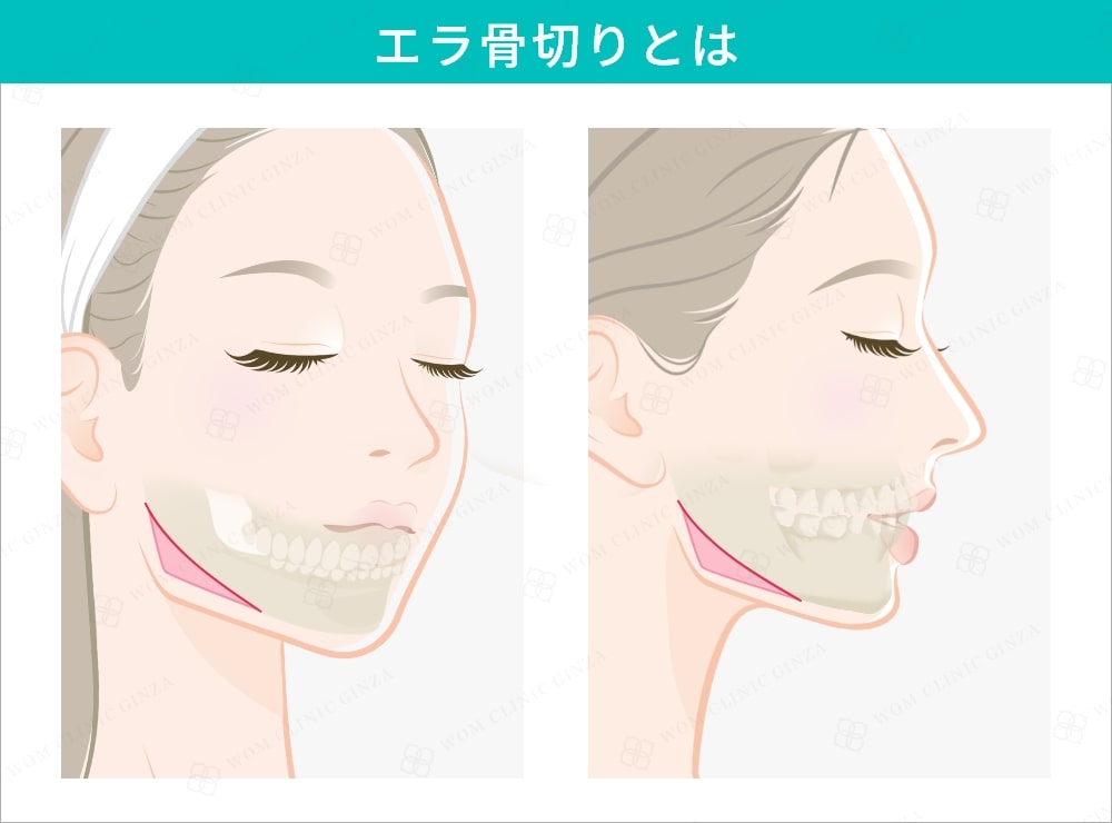 エラ骨切りとは