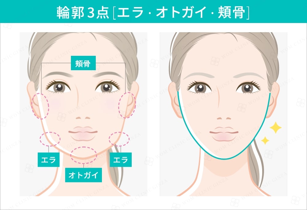 輪郭3点（エラ・オトガイ・頬骨）