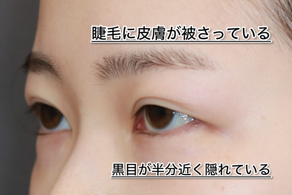 『ぱっちりしない目元…“二重手術のやり直し”でここまで変わる』の画像