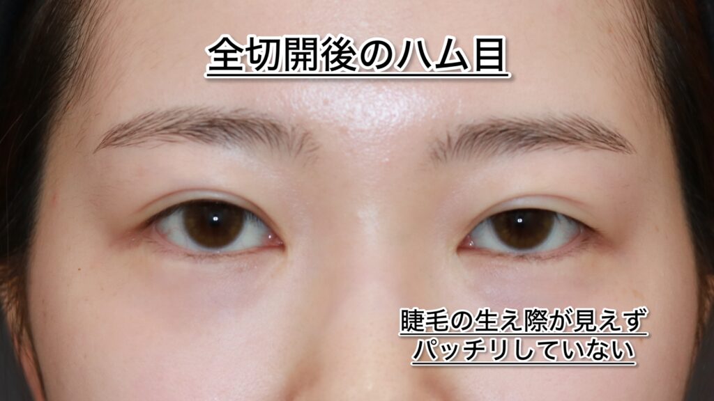 『ぱっちりしない目元…“二重手術のやり直し”でここまで変わる』の画像