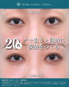 裏ハムラ法＋涙袋形成の症例写真
