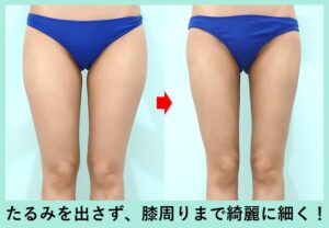 太もも全周+膝周り+下臀部の脂肪吸引の症例写真