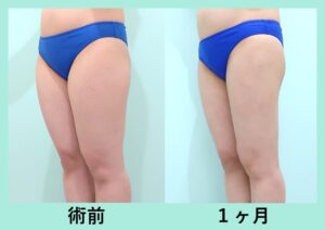 太もも全周+下臀部の脂肪吸引の写真写真