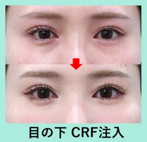目の下の脂肪注入の症例写真