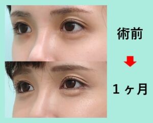 目の下の脂肪注入の症例写真2