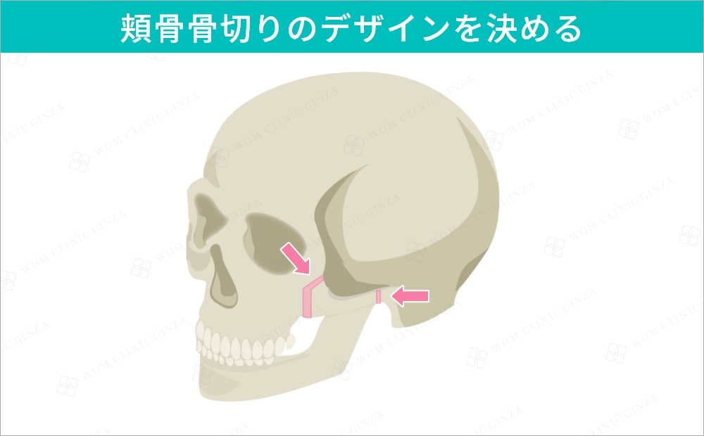 頬骨骨切りのデザインを決める