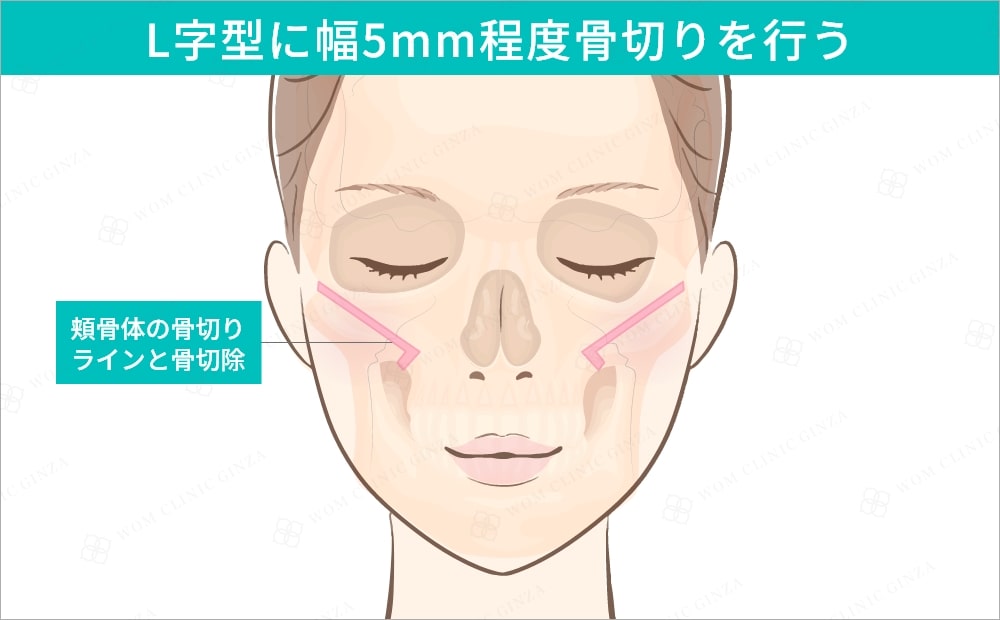 L字型に幅5mm程度骨切りを行う